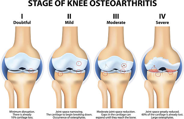 Physiotherapy at Home for Osteoarthritis in the Knee Joint.